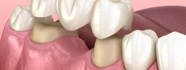 what happens if a dental bridge feels loose