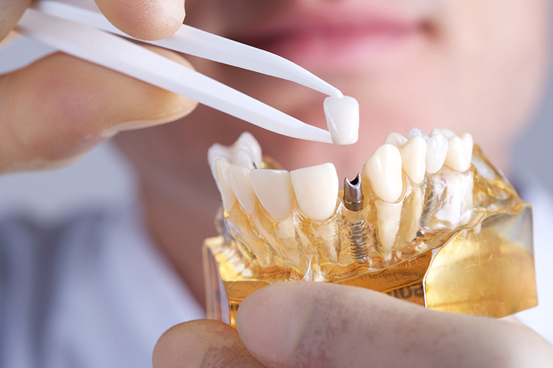 Precision Dental Implant Surgery: Restoring Smiles with Expertise