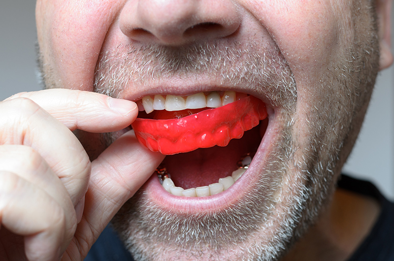 mouthguards in mokena