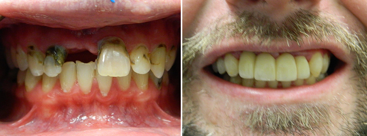 dental crowns treatment near you