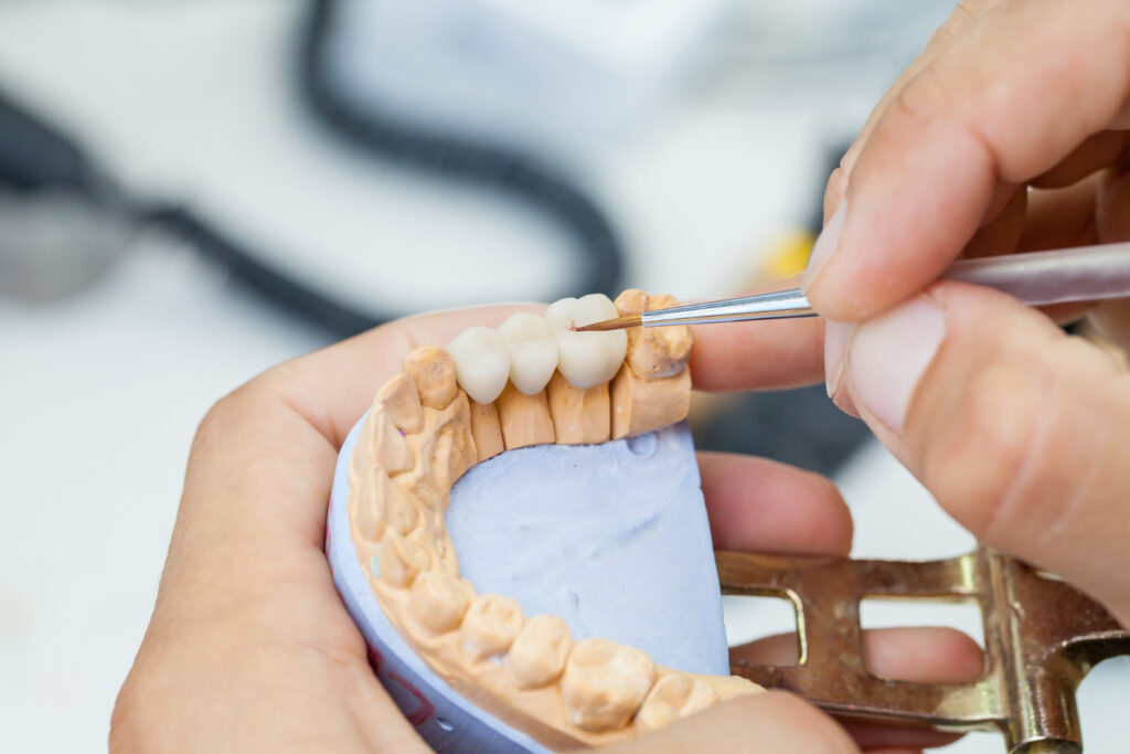 what are the different types of bridges for teeth