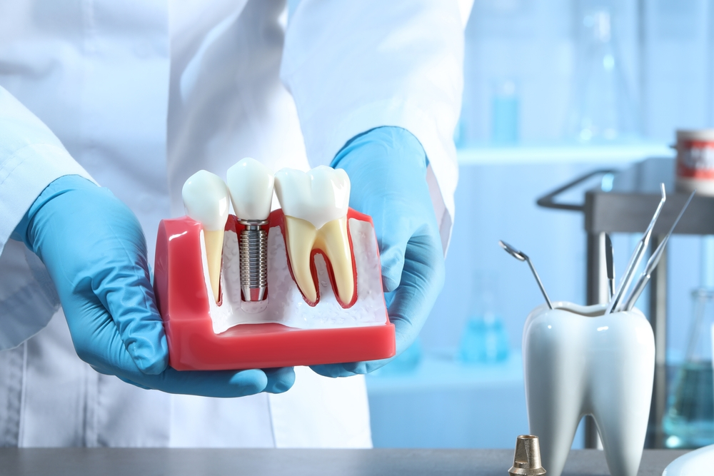 unraveling the mystery can dental implants get cavities
