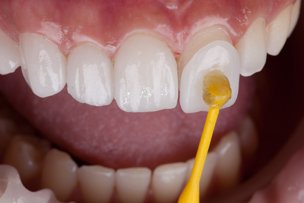porcelain veneers near you