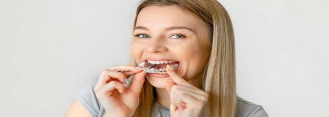 clear aligners