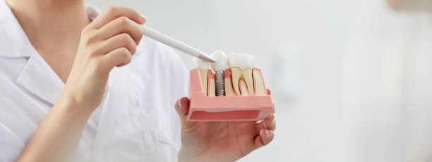 smile makeovers with dental implants
