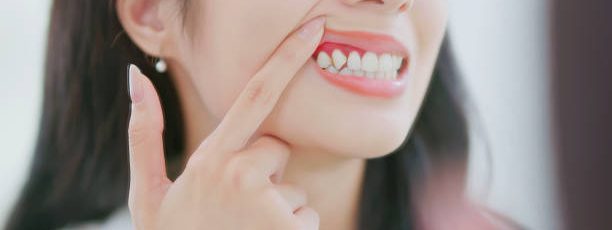 stages of gum disease