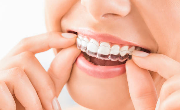 how do mouthguards protect your teeth
