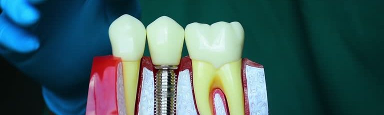 how to care for your dental implants long term