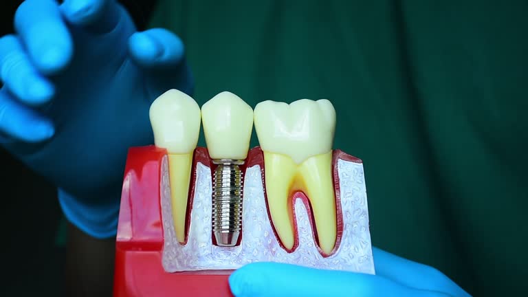 how to care for your dental implants long term